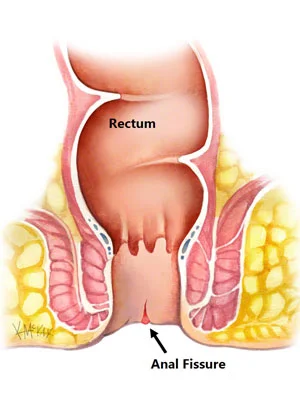 Anal Fissure