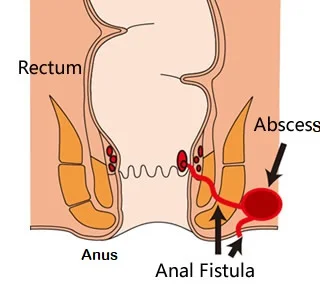 fistula